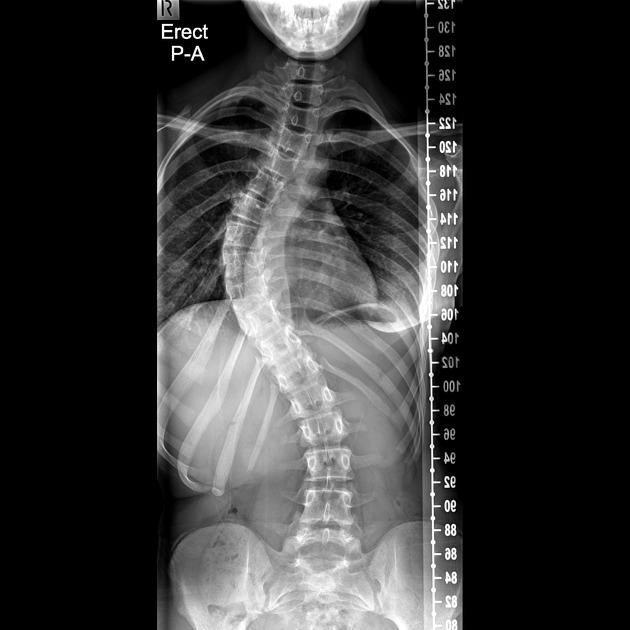How Scoliosis Affects Young Athletes